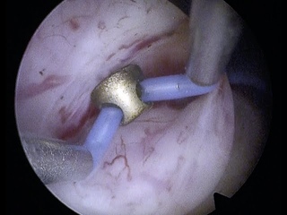 EN BLOCK BIPOLAR ENUCLEATION OF PROSTATE